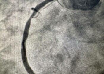 Tunisie : une première africaine avec l&rsquo;implantation d&rsquo;un stent coronaire résorbable de troisième génération