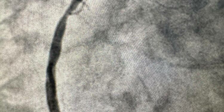 Tunisie : une première africaine avec l&rsquo;implantation d&rsquo;un stent coronaire résorbable de troisième génération
